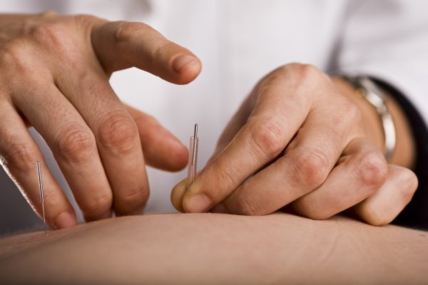 Acupuncturist prepares to tap needle into patients hand